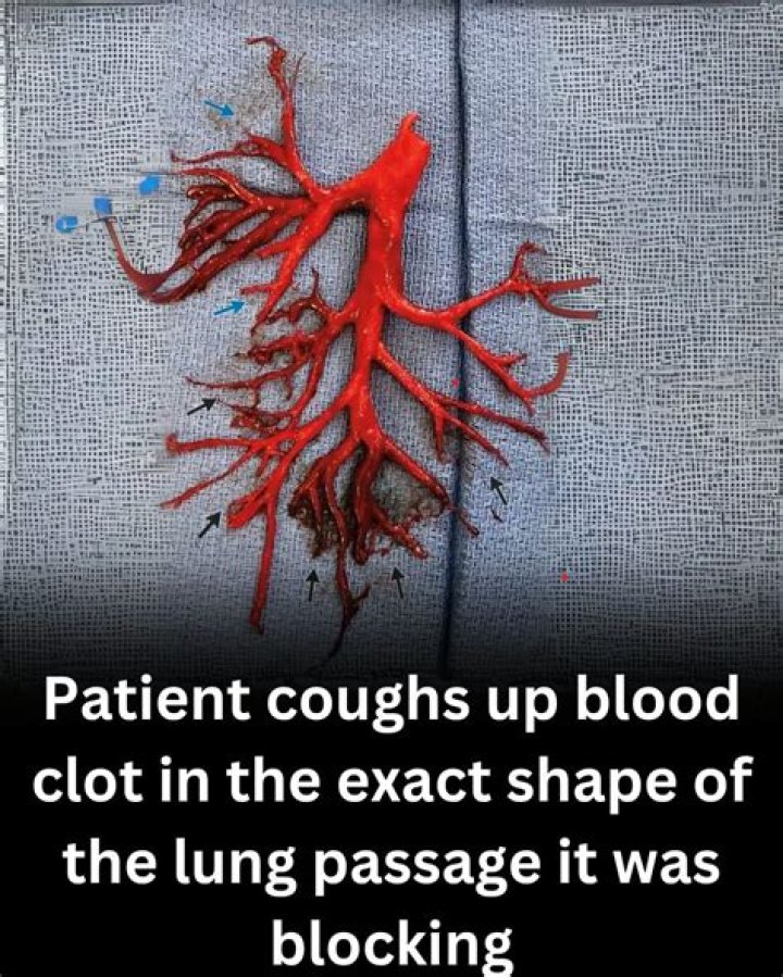 Man Coughs Up Blood Clot In The Exact Shape Of His Lung Passage